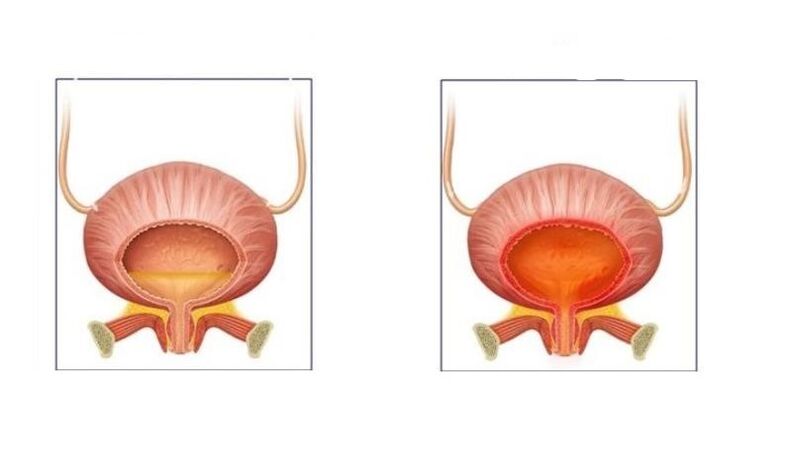 Normali și pacienți cu cistită a tractului urinar