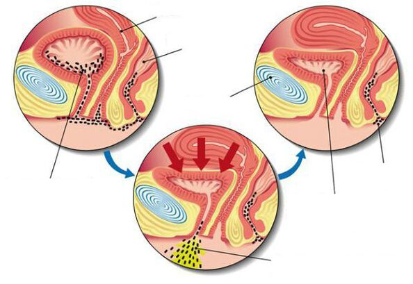 bacterii din vezica urinara cu cistita