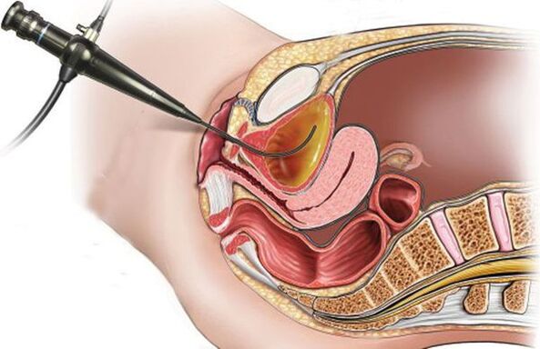 cistoscopie pentru cistita