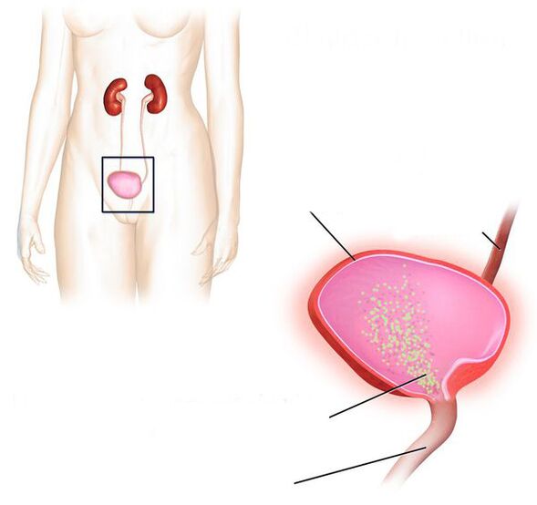 inflamația vezicii urinare
